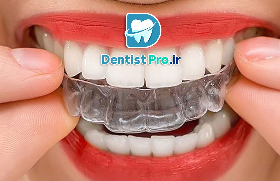 هزینه ارتودنسی نامرئی با کیفیت