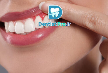 درمان قطعی بوی بد دهان ناشی از لثه