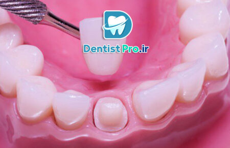 ترمیم تاج دندان با روکش زیرکونیا؛ راهنمای کامل و تخصصی