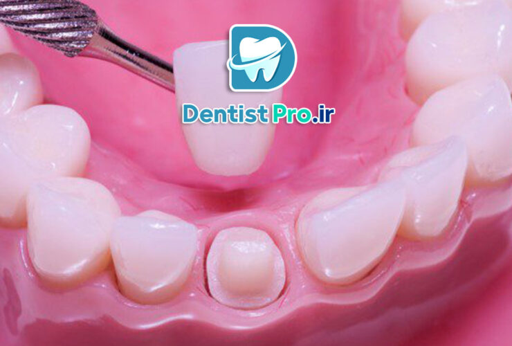 ترمیم تاج دندان با روکش زیرکونیا؛ راهنمای کامل و تخصصی 27 ترمیم تاج دندان با روکش زیرکونیا؛ راهنمای کامل و تخصصی