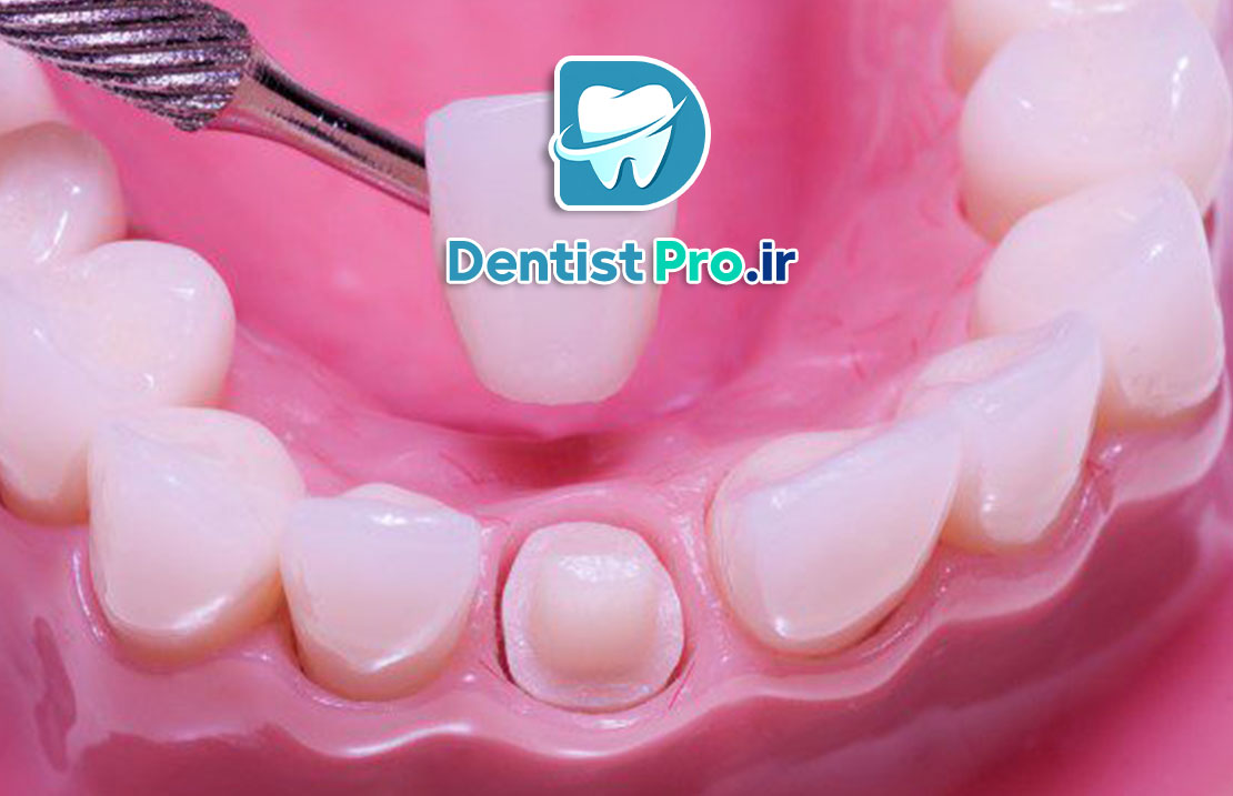 ترمیم تاج دندان با روکش زیرکونیا؛ راهنمای کامل و تخصصی