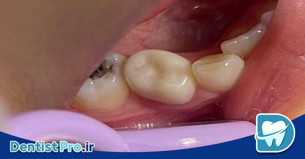 ترمیم تاج دندان با روکش زیرکونیا؛ راهنمای کامل و تخصصی