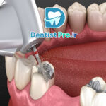 ترمیم دندان با آمالگام یا کامپوزیت