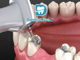 ترمیم دندان با آمالگام یا کامپوزیت