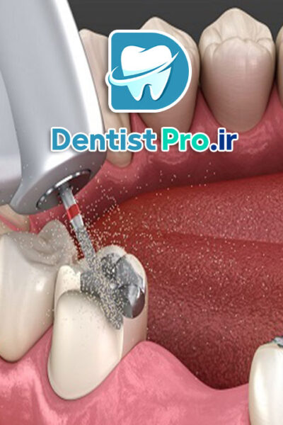 ترمیم دندان با آمالگام یا کامپوزیت