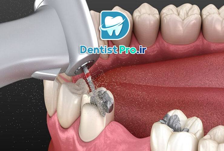 ترمیم دندان با آمالگام یا کامپوزیت 31 ترمیم دندان با آمالگام یا کامپوزیت