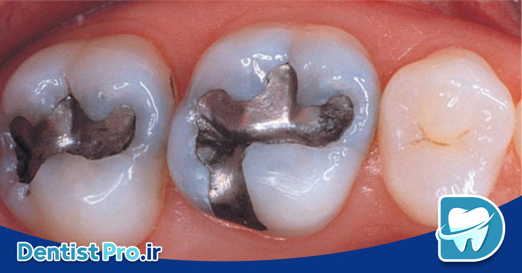 ترمیم دندان با آمالگام یا کامپوزیت