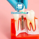 تفاوت ایمپلنت کره ای و آلمانی از نظر کیفیت