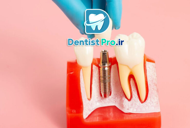 تفاوت ایمپلنت کره ای و آلمانی از نظر کیفیت