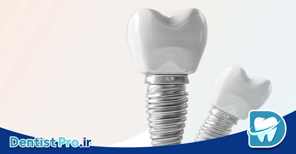 تفاوت ایمپلنت کره ای و آلمانی از نظر کیفیت