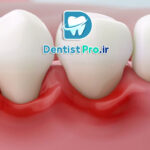 ایمپلنت دیجیتال با قالب گیری سه بعدی دقیق