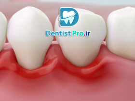 ایمپلنت دیجیتال با قالب گیری سه بعدی دقیق