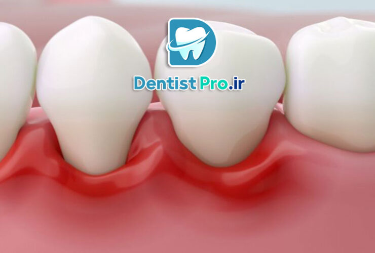 ایمپلنت دیجیتال با قالب گیری سه بعدی دقیق