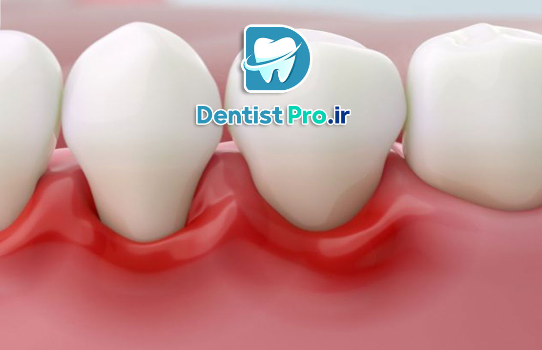 ایمپلنت دیجیتال با قالب گیری سه بعدی دقیق