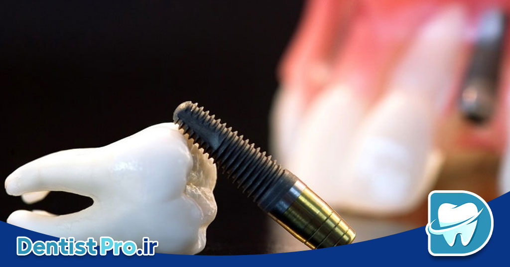 ایمپلنت دیجیتال با قالب گیری سه بعدی دقیق