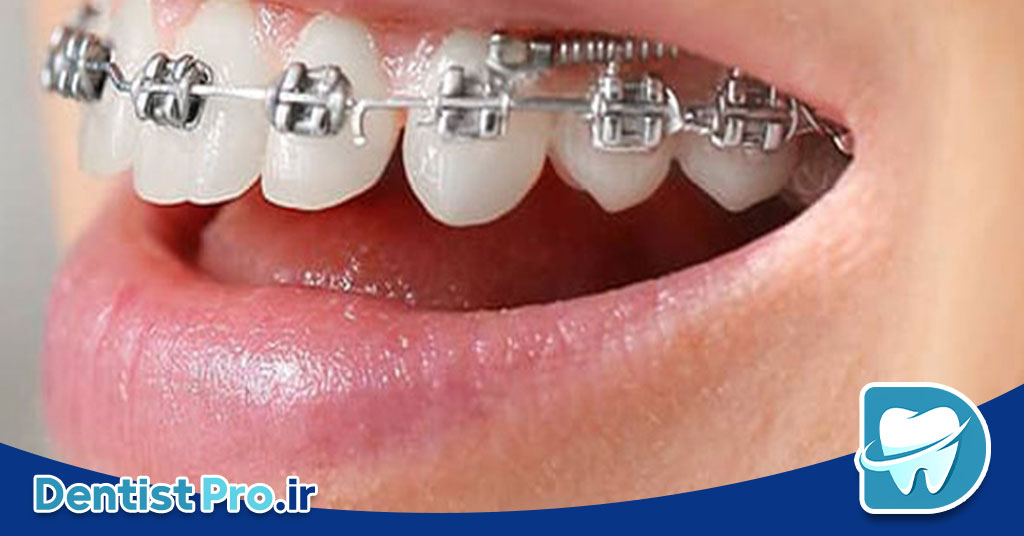 ارتودنسی سریع با mini screw