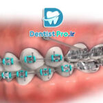 ارتودنسی سریع با mini screw