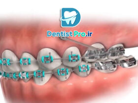 ارتودنسی سریع با mini screw