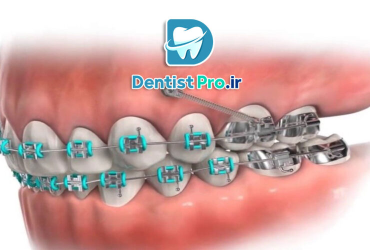 ارتودنسی سریع با mini screw