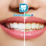 رفع زردی ژنتیکی دندان بدون آسیب مینای دندان