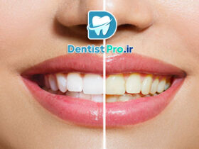 رفع زردی ژنتیکی دندان بدون آسیب مینای دندان