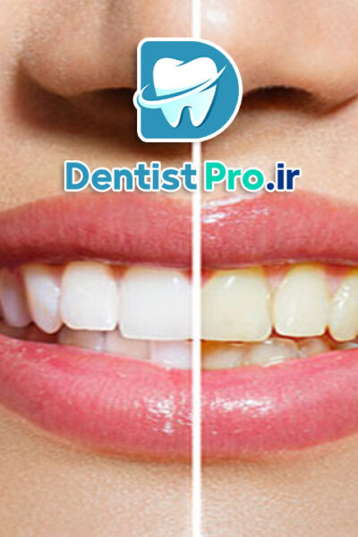 رفع زردی ژنتیکی دندان بدون آسیب مینای دندان
