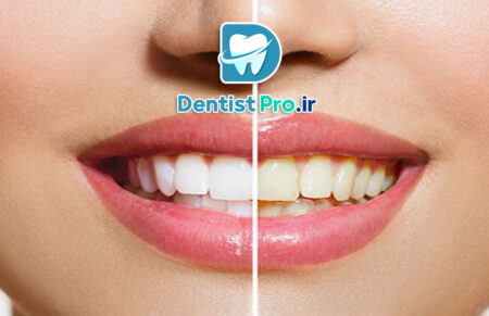 رفع زردی ژنتیکی دندان بدون آسیب مینای دندان