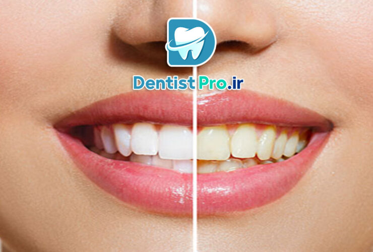 رفع زردی ژنتیکی دندان بدون آسیب مینای دندان 39 رفع زردی ژنتیکی دندان بدون آسیب مینای دندان