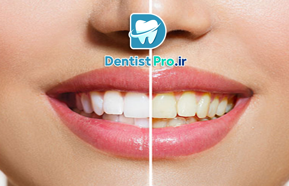 رفع زردی ژنتیکی دندان بدون آسیب مینای دندان