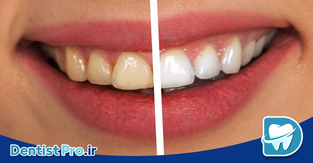 رفع زردی ژنتیکی دندان بدون آسیب مینای دندان