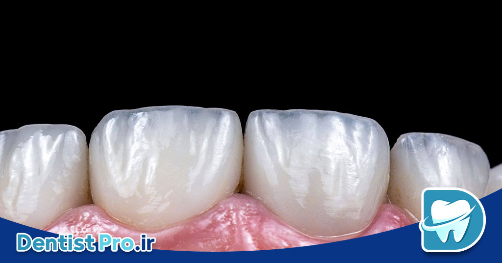 رفع ناصافی سطح دندان بدون تراش چگونه انجام میشود؟