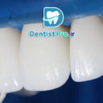 رفع ناصافی سطح دندان بدون تراش چگونه انجام میشود؟