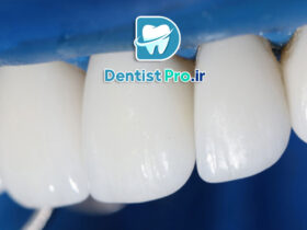 رفع ناصافی سطح دندان بدون تراش چگونه انجام میشود؟