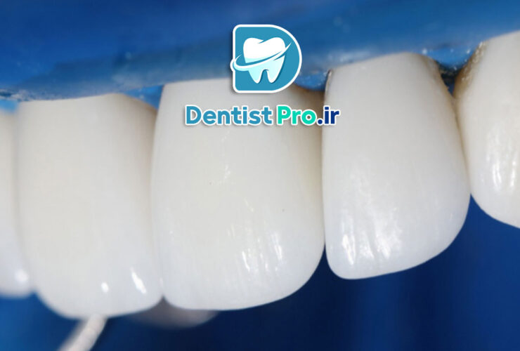 رفع ناصافی سطح دندان بدون تراش چگونه انجام میشود؟