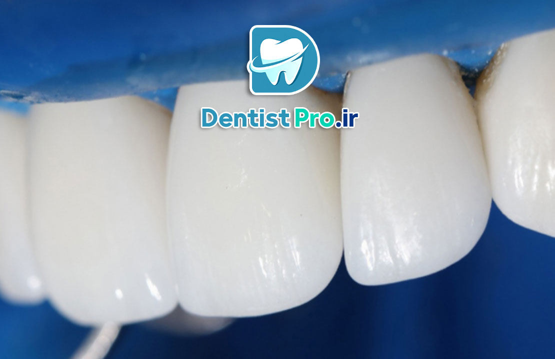 رفع ناصافی سطح دندان بدون تراش چگونه انجام میشود؟