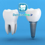 ایمپلنت بدون جراحی flapless با کمترین درد