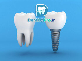 ایمپلنت بدون جراحی flapless با کمترین درد