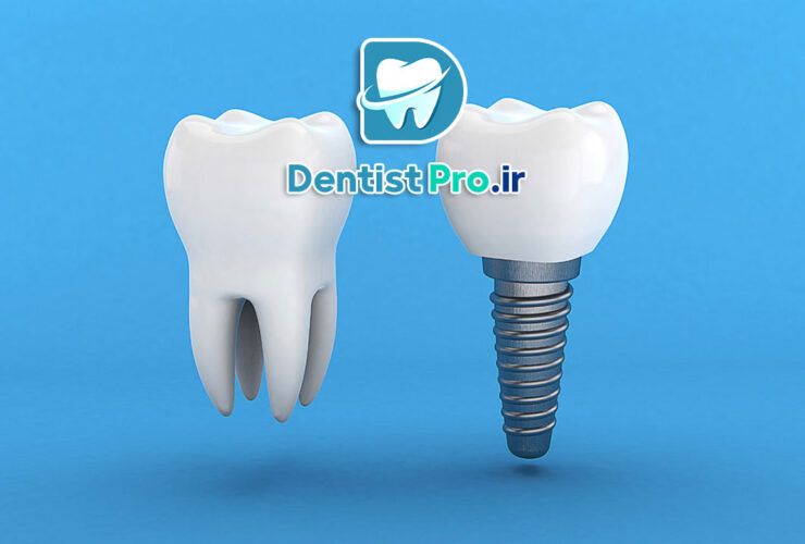 ایمپلنت بدون جراحی flapless با کمترین درد