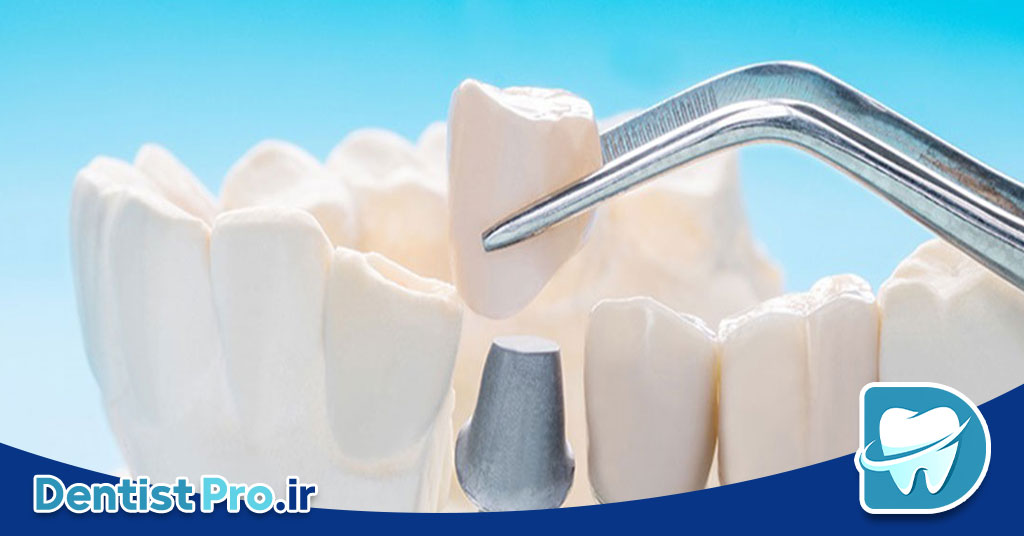 ایمپلنت بدون جراحی flapless با کمترین درد