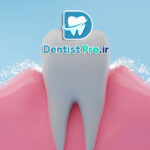 فلورایدتراپی برای پیشگیری از پوسیدگی چگونه انجام میشود؟