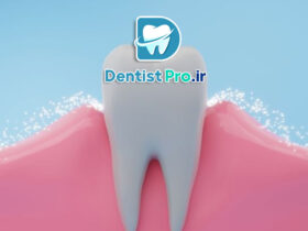 فلورایدتراپی برای پیشگیری از پوسیدگی چگونه انجام میشود؟