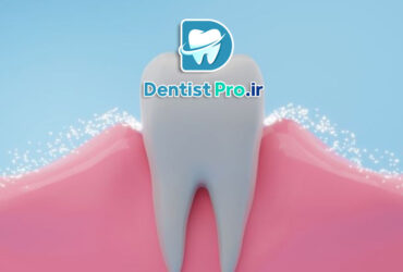 فلورایدتراپی برای پیشگیری از پوسیدگی چگونه انجام میشود؟