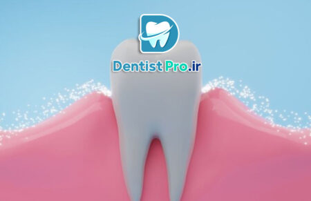 فلورایدتراپی برای پیشگیری از پوسیدگی چگونه انجام میشود؟