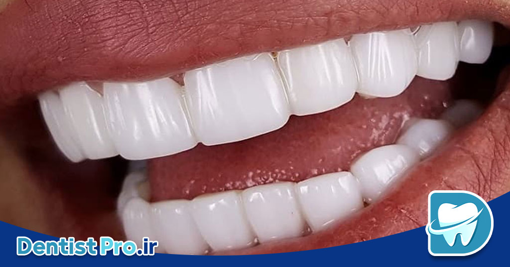 کامپوزیت دندان جلو برای رفع لب پریدگی