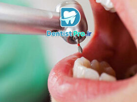 کامپوزیت دندان جلو برای رفع لب پریدگی