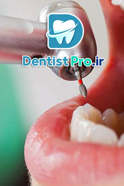 کامپوزیت دندان جلو برای رفع لب پریدگی