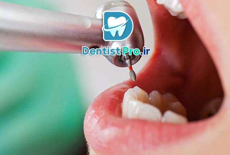 کامپوزیت دندان جلو برای رفع لب پریدگی 35 کامپوزیت دندان جلو برای رفع لب پریدگی