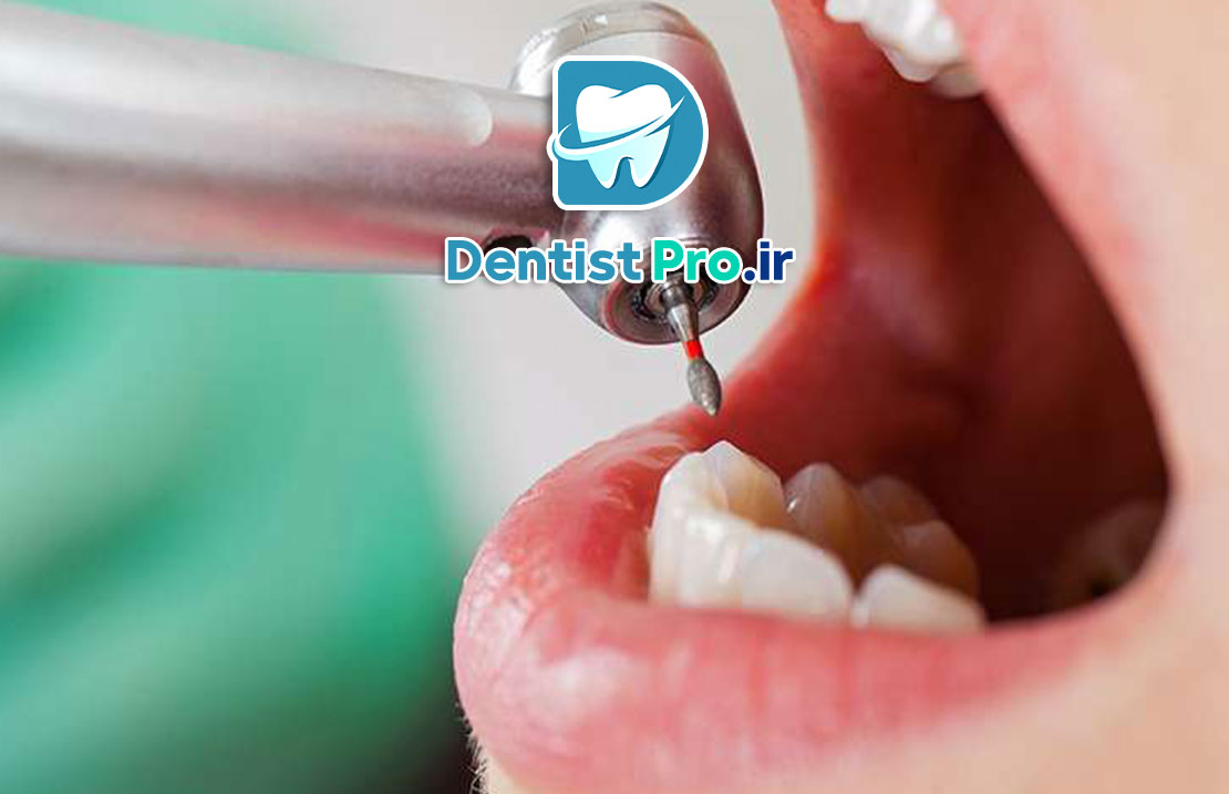 کامپوزیت دندان جلو برای رفع لب پریدگی