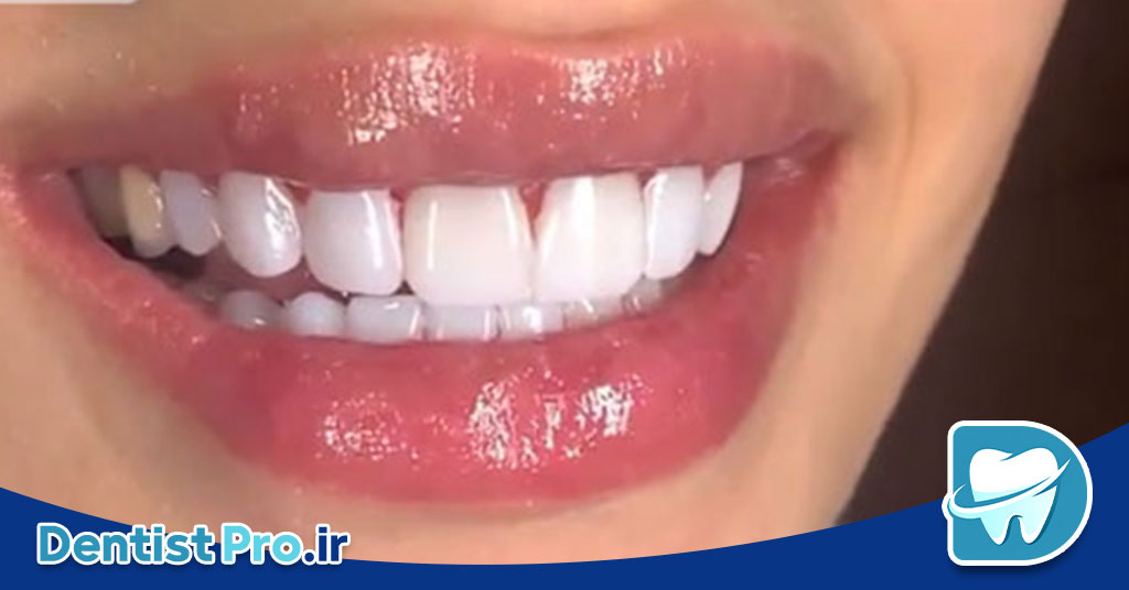 روکش دندان جلو برای اصلاح لبخند طبیعی