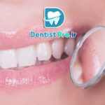 روکش دندان جلو برای اصلاح لبخند طبیعی